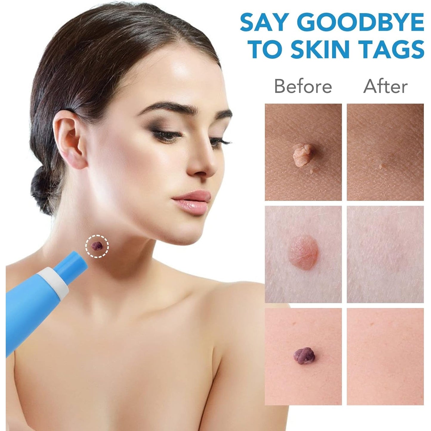 Skin Tag Remover Kit 2 in 1 for Micro to Large (2 mm - 8 mm / 1 Set)